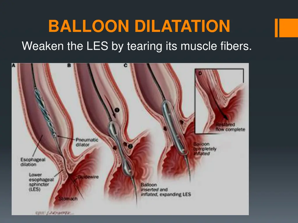 balloon dilatation weaken the les by tearing