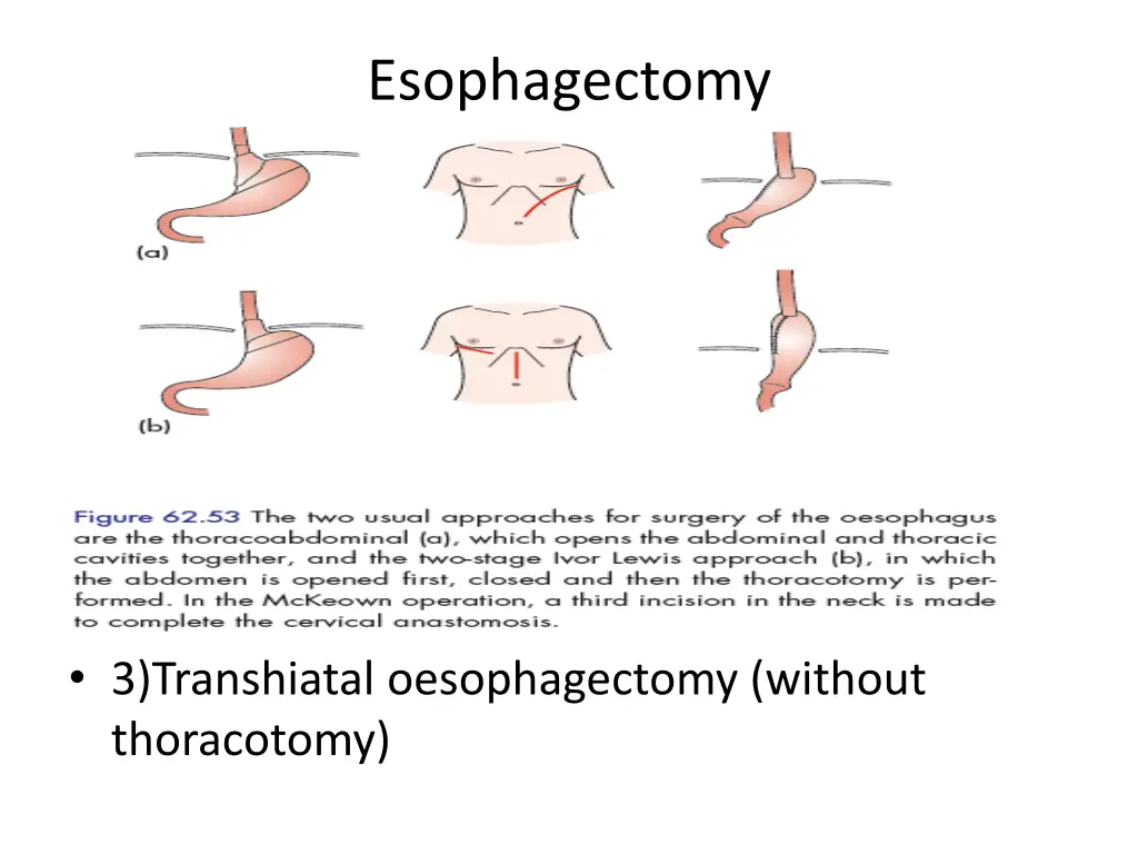 esophagectomy