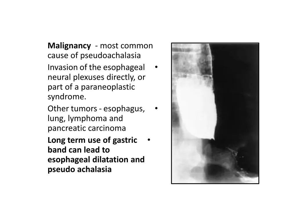 malignancy most common cause of pseudoachalasia