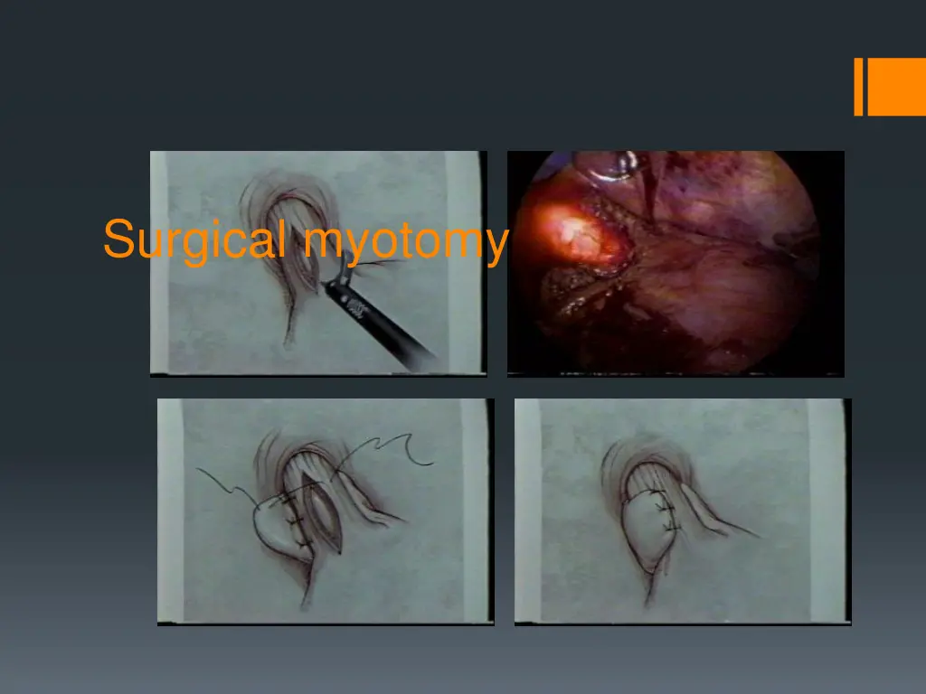 surgical myotomy