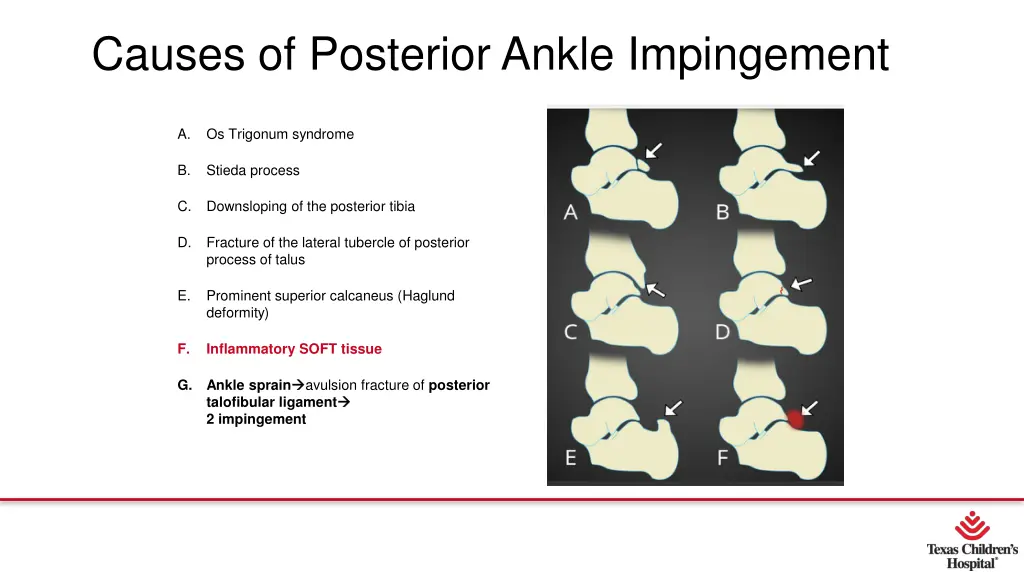 causes of posterior ankle impingement