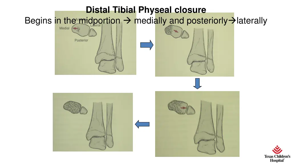 distal tibial physeal closure