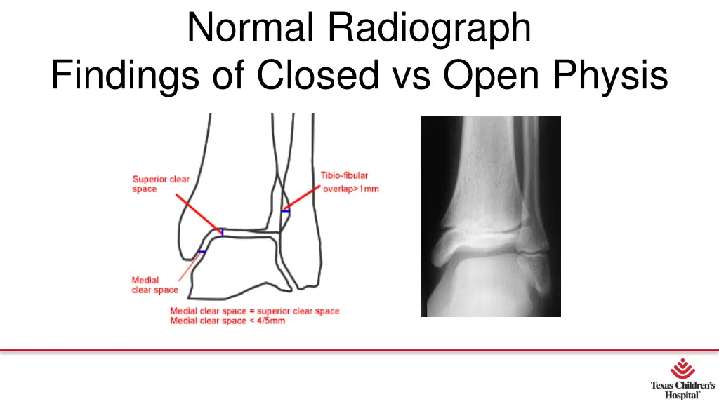 normal radiograph findings of closed vs open