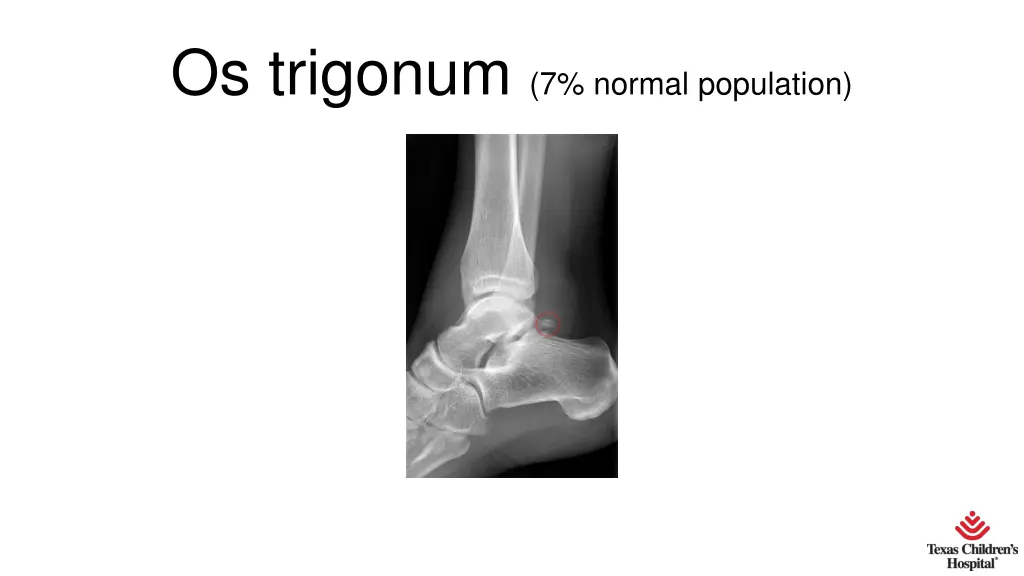 os trigonum 7 normal population