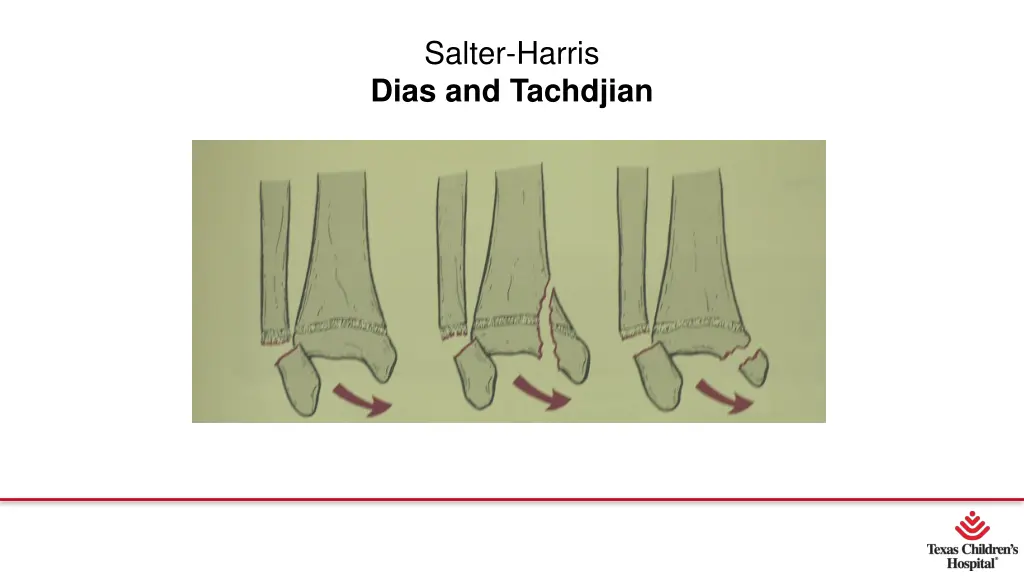 salter harris dias and tachdjian