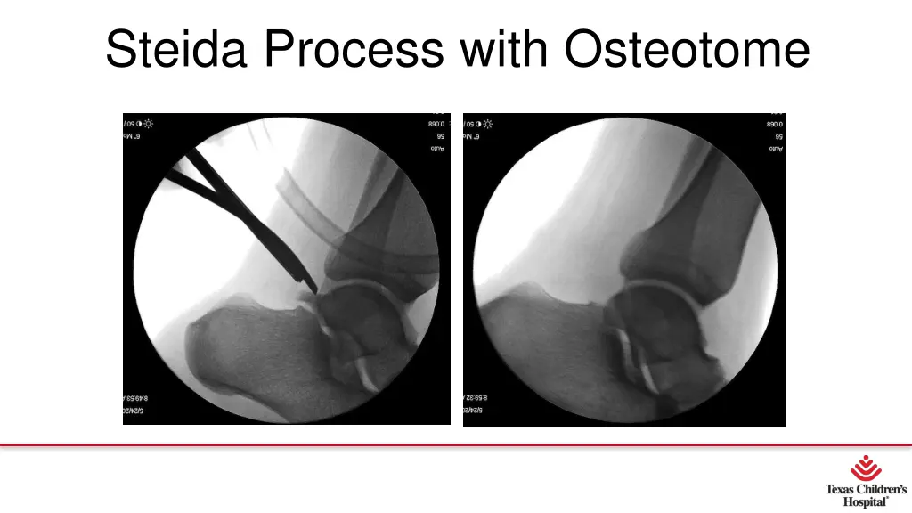 steida process with osteotome