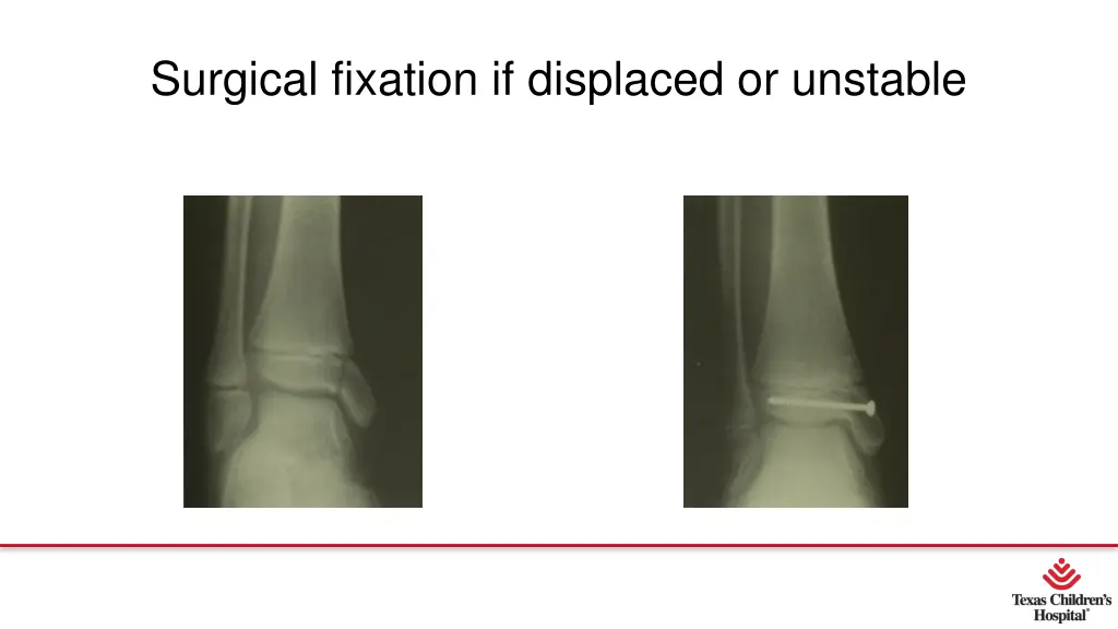 surgical fixation if displaced or unstable