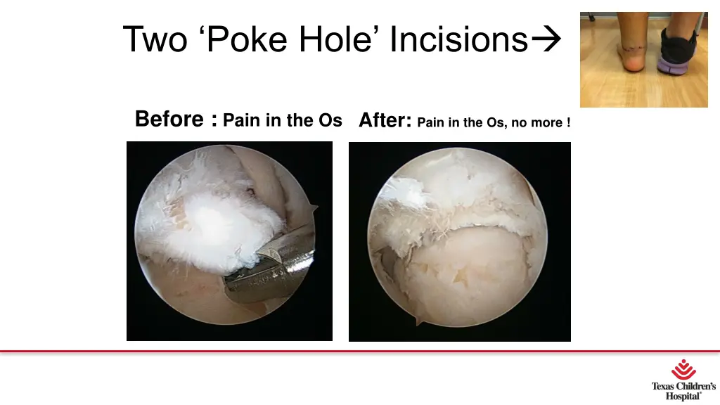 two poke hole incisions