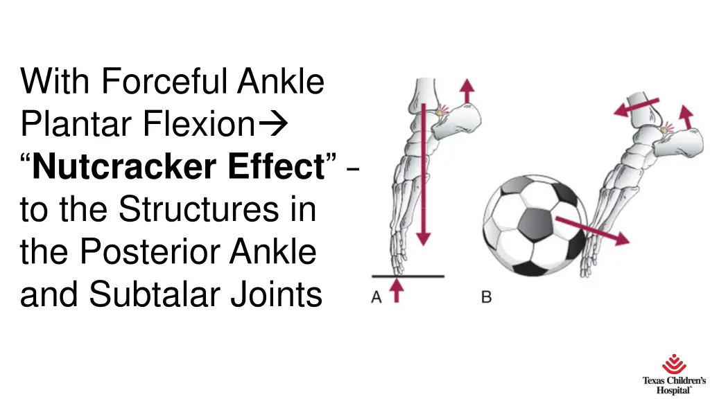 with forceful ankle plantar flexion nutcracker