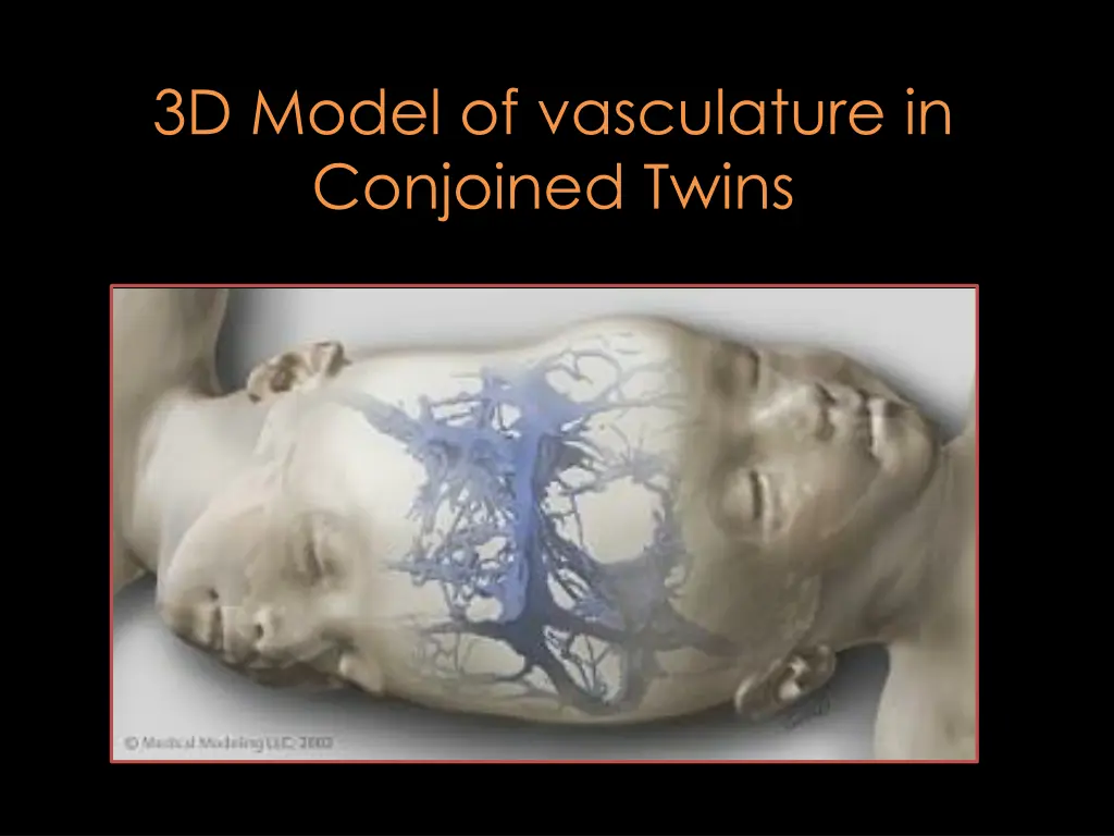 3d model of vasculature in conjoined twins