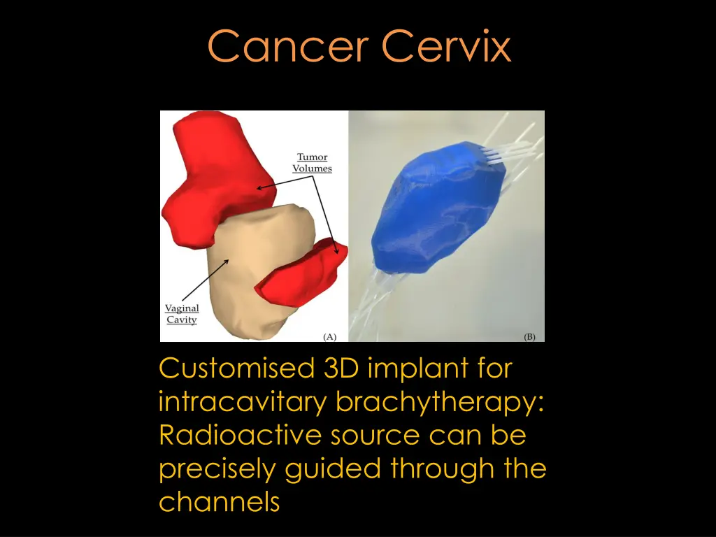 cancer cervix