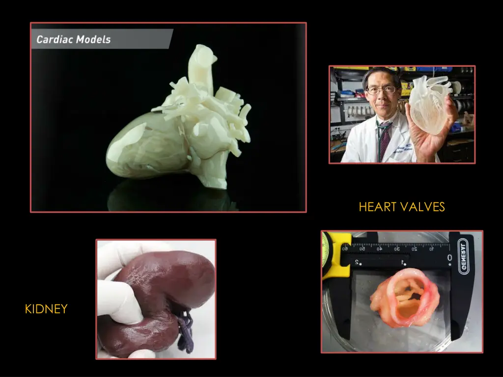 heart valves