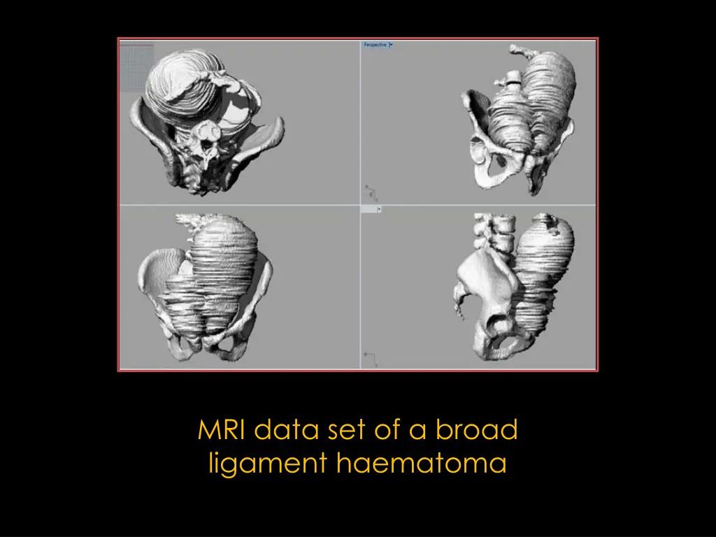 mri data set of a broad ligament haematoma