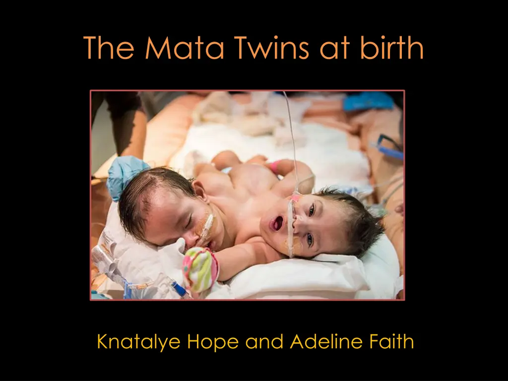 the mata twins at birth