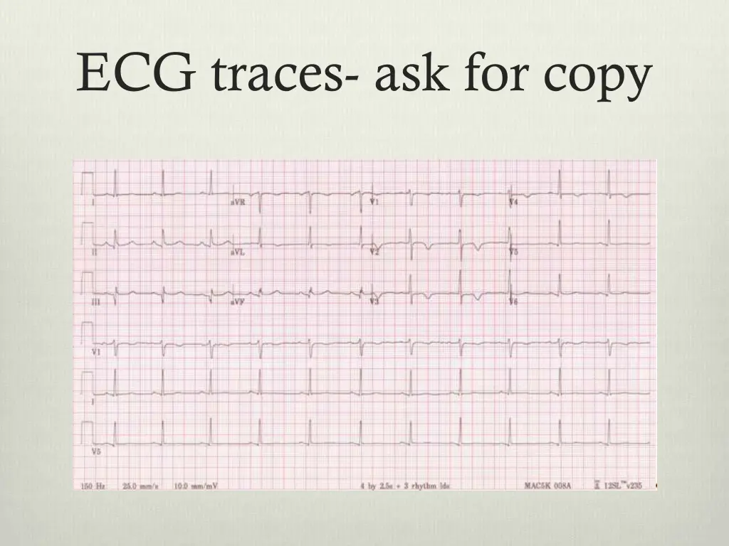 ecg traces ask for copy