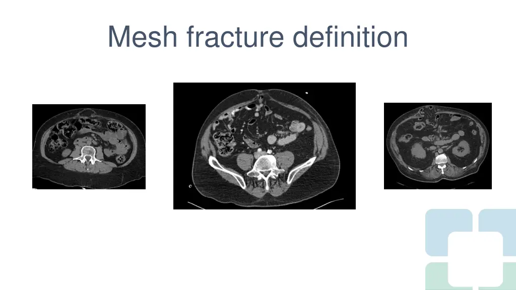 mesh fracture definition