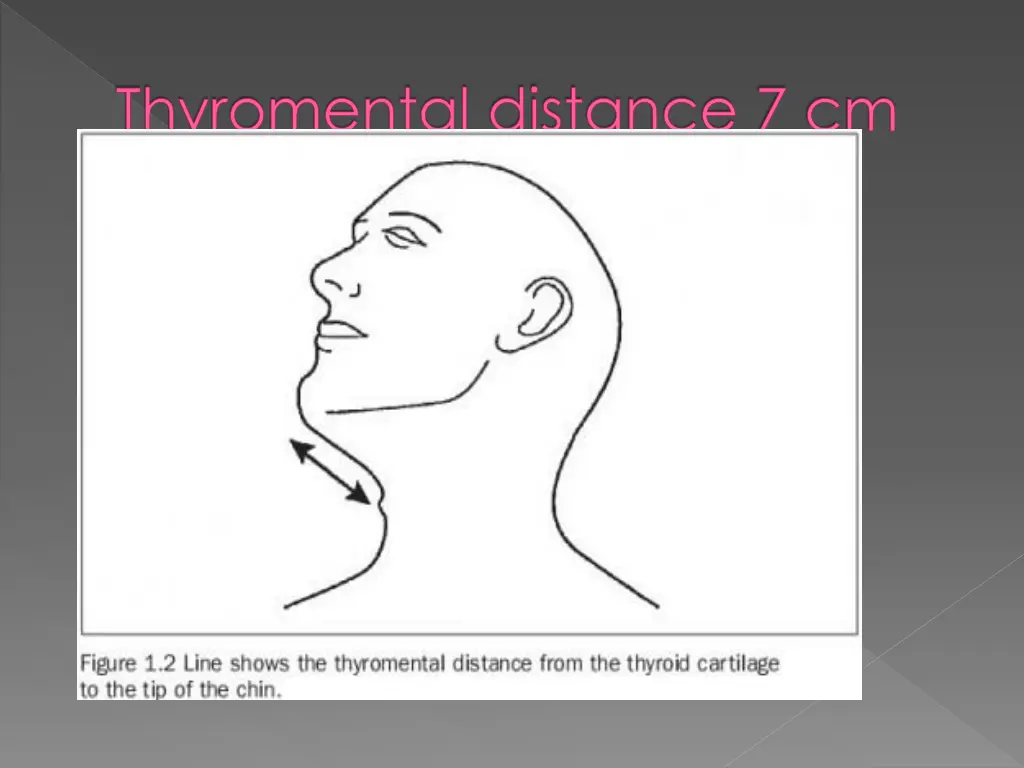 thyromental distance 7 cm