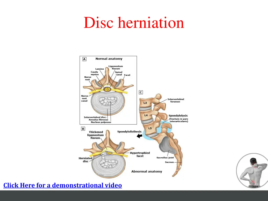 disc herniation