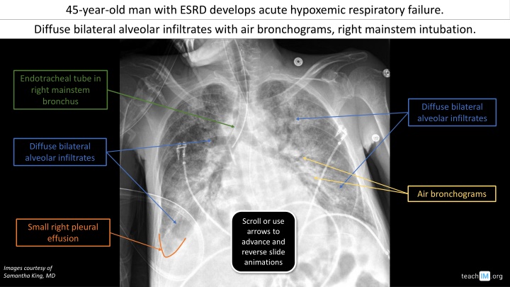 45 year old man with esrd develops acute