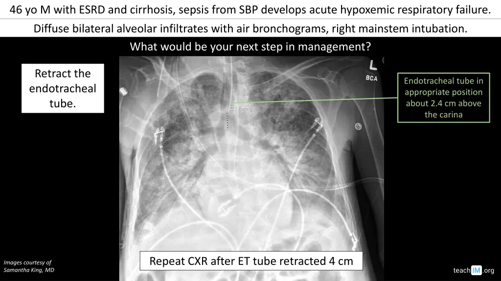 46 yo m with esrd and cirrhosis sepsis from 1