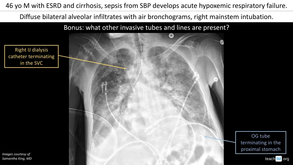 46 yo m with esrd and cirrhosis sepsis from 2