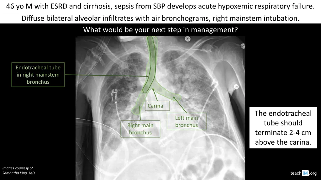 46 yo m with esrd and cirrhosis sepsis from