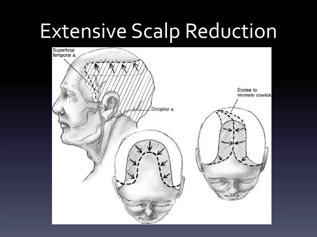 extensive scalp reduction 3