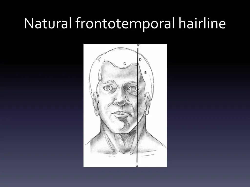 natural frontotemporalhairline