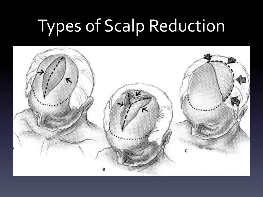 types of scalp reduction