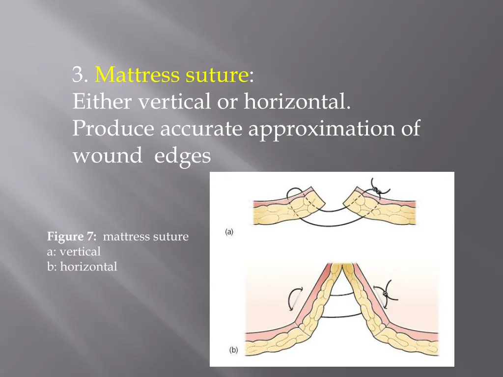 3 mattress suture either vertical or horizontal