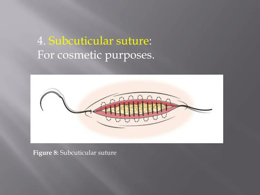 4 subcuticular suture for cosmetic purposes