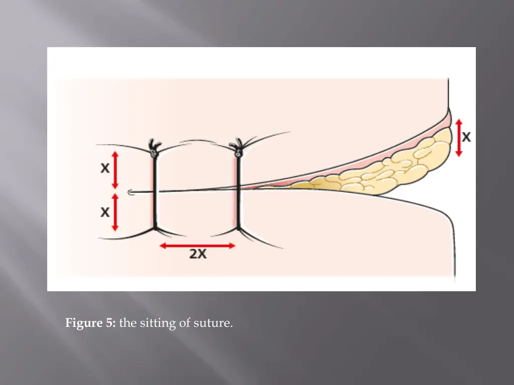 figure 5 the sitting of suture