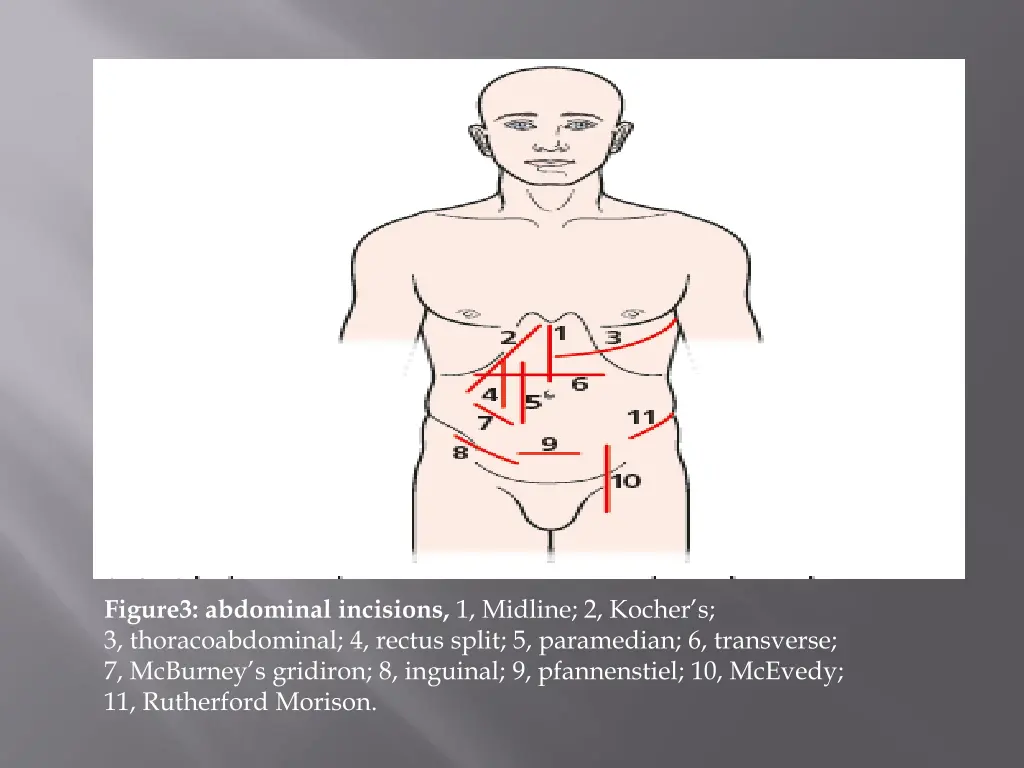 figure3 abdominal incisions 1 midline 2 kocher