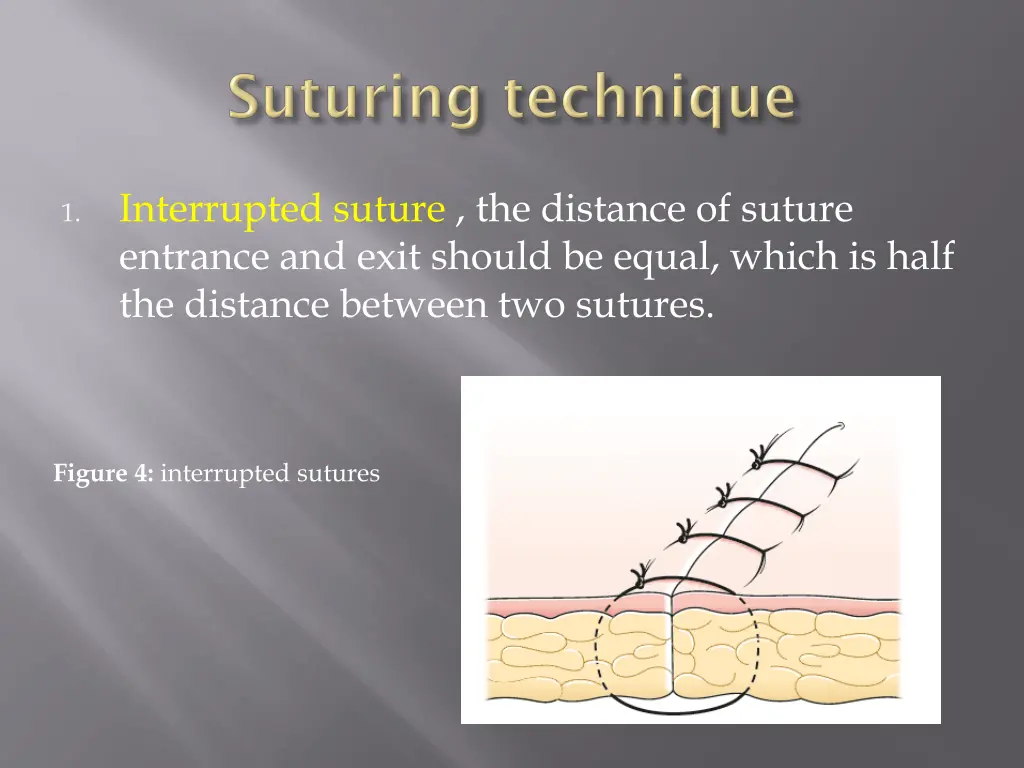 interrupted suture the distance of suture