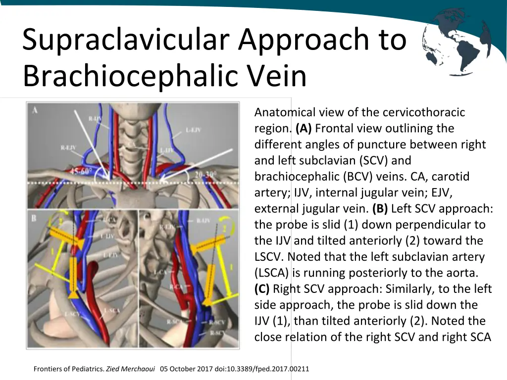 supraclavicular approach to brachiocephalic vein