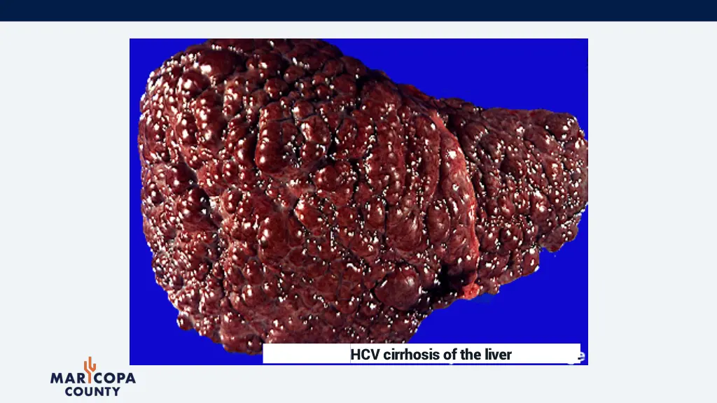 hcv cirrhosis of the liver