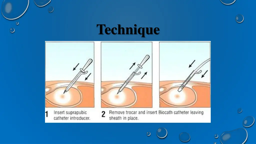 technique 3