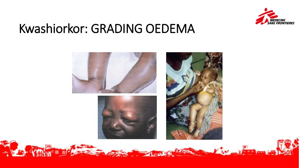 kwashiorkor grading oedema kwashiorkor grading