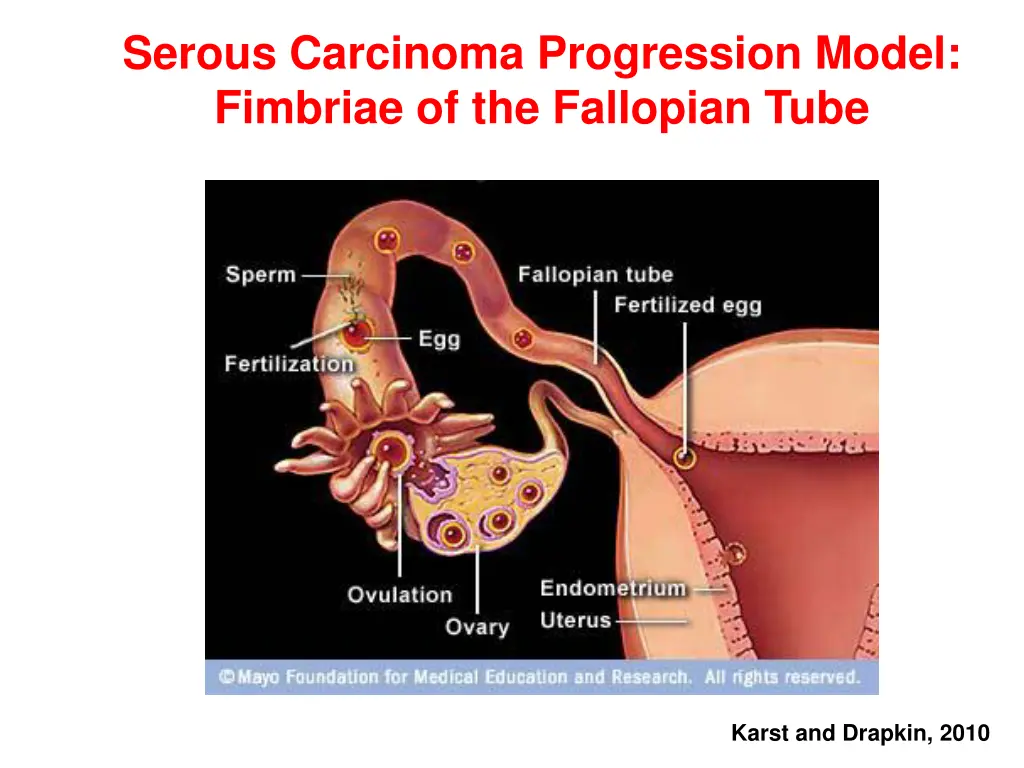 serous carcinoma progression model fimbriae