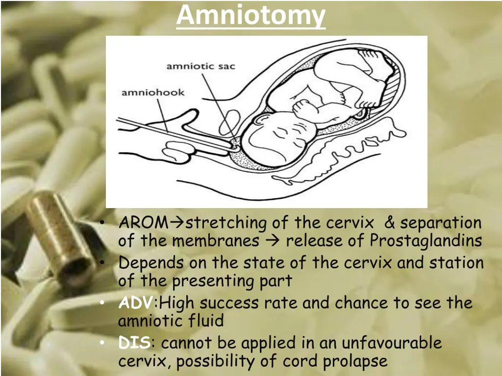 amniotomy