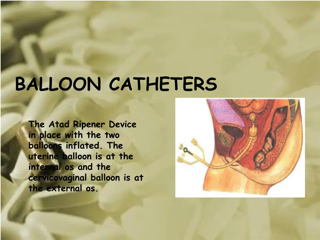 balloon catheters