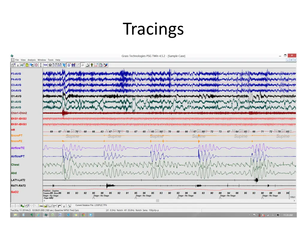 tracings