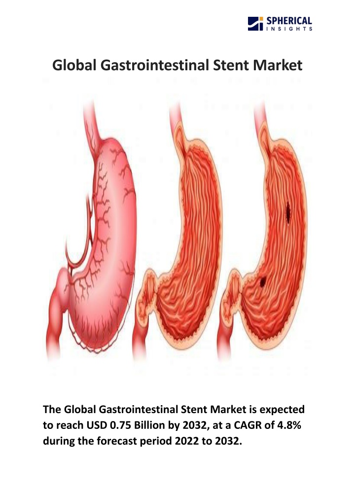 global gastrointestinal stent market