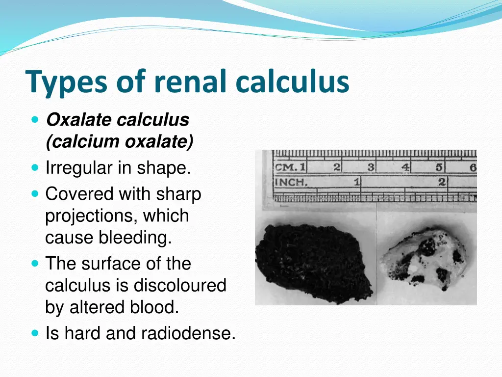 types of renal calculus oxalate calculus calcium