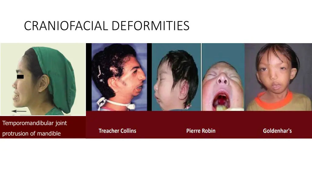 craniofacial deformities