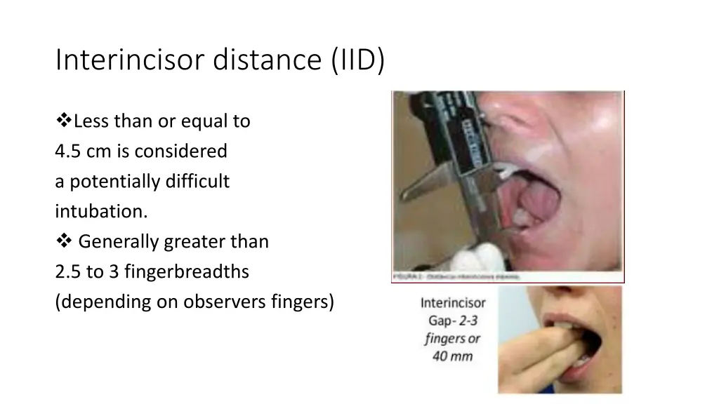 interincisor distance iid