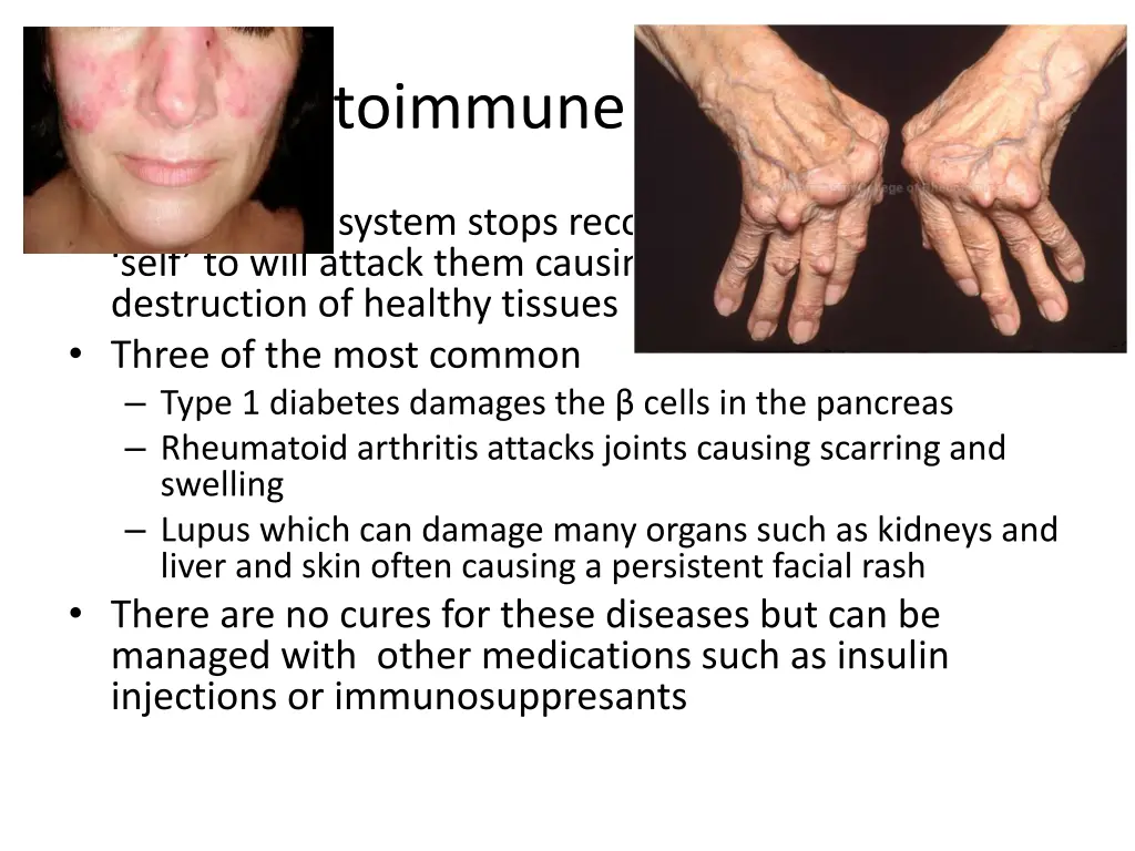 autoimmune diseases