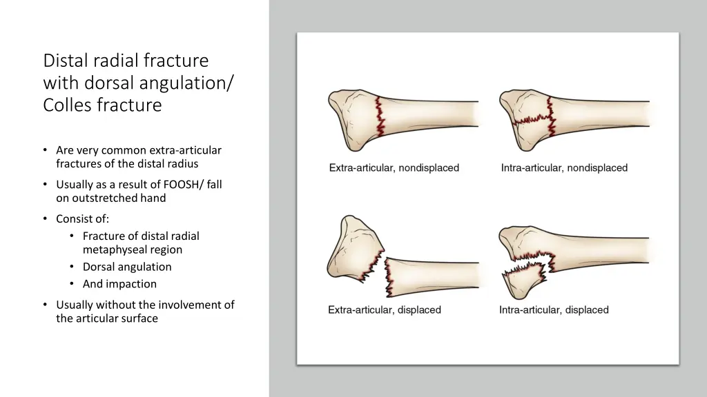 distal radial fracture with dorsal angulation