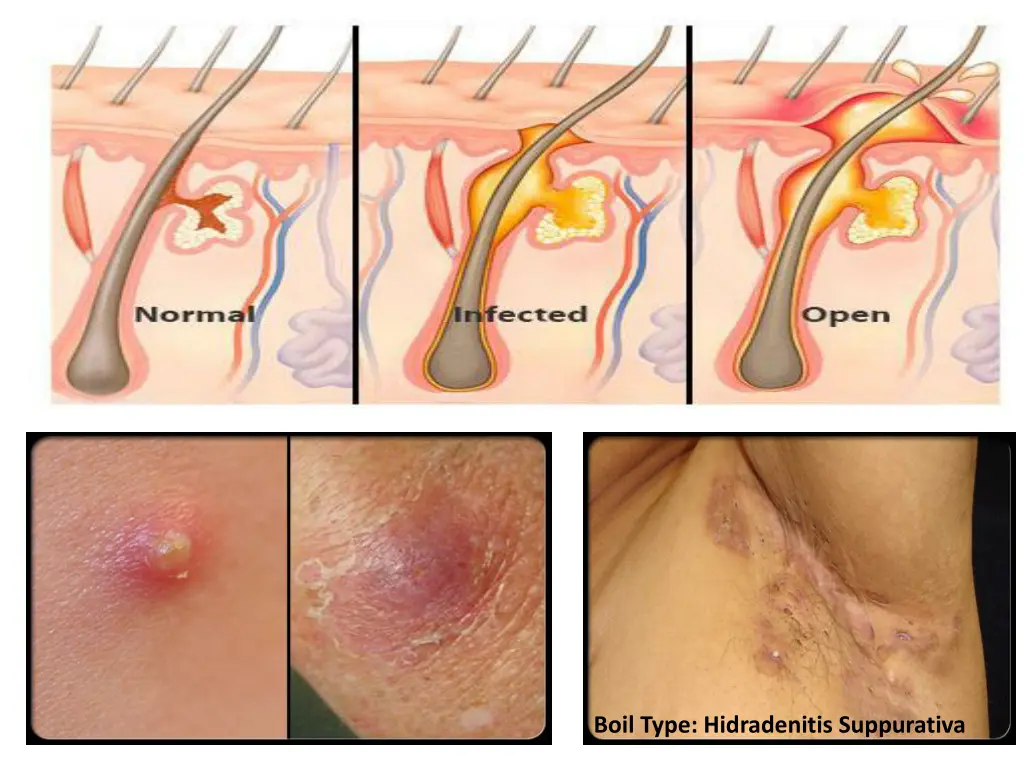 boil type hidradenitis suppurativa