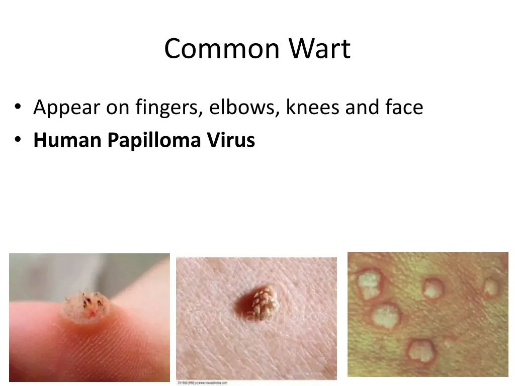 common wart